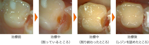 虫歯の治療