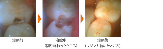 虫歯の治療