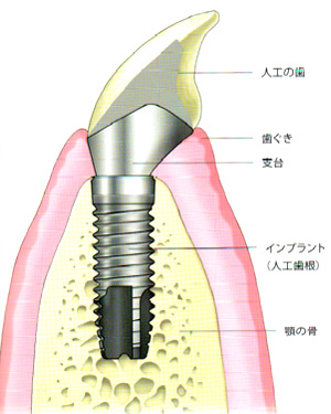 インプラント