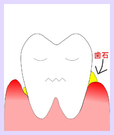 歯石が付着　歯肉が炎症