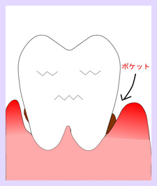 歯肉が炎症　ポケットが出来ている