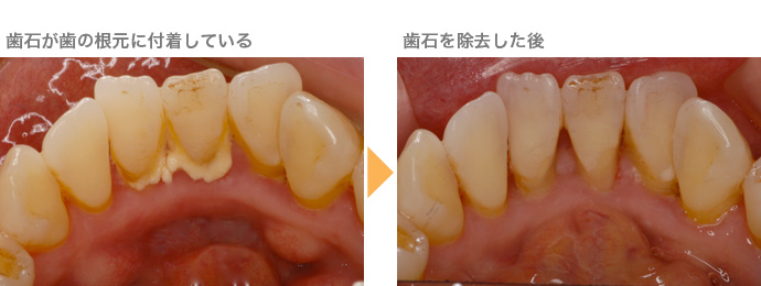 歯石が歯の根元に付着している→歯石を除去した後