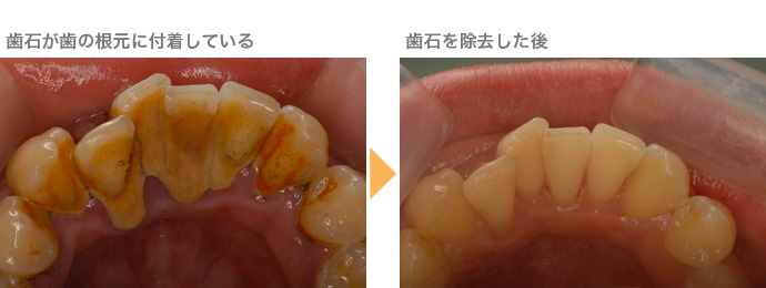 歯石が歯の根元に付着している→歯石を除去した後