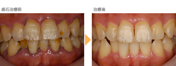 歯石治療前治療後