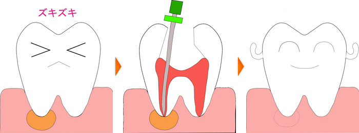 根管治療イラスト