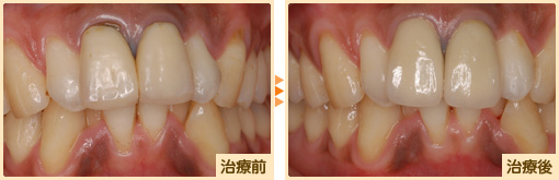 オールセラミック治療前治療後