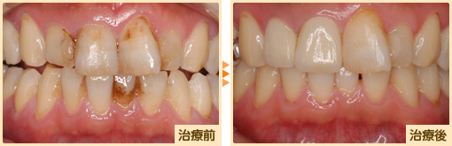 オールセラミック治療前治療後