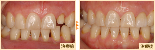 オールセラミック治療前治療後