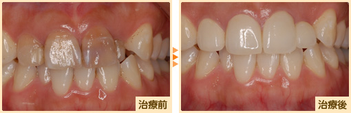 オールセラミック治療前治療後