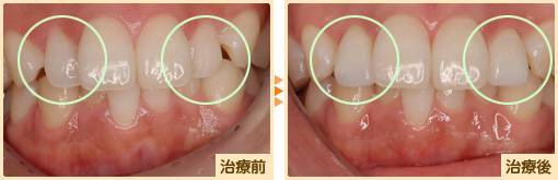 ラミネートベニア治療前治療後