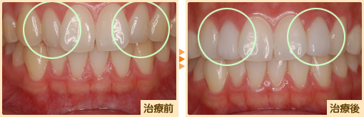 ラミネートベニア治療前治療後