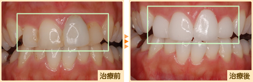 ラミネートベニア治療前治療後