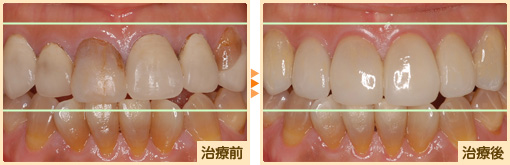 ラミネートベニア治療前治療後