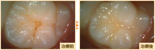 レジン治療前治療後