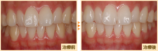 ホワイトニング治療前治療後