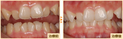 ホワイトニング治療前治療後