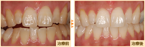 ホワイトニング治療前治療後