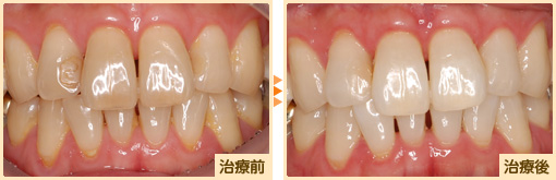 ホワイトニング治療前治療後